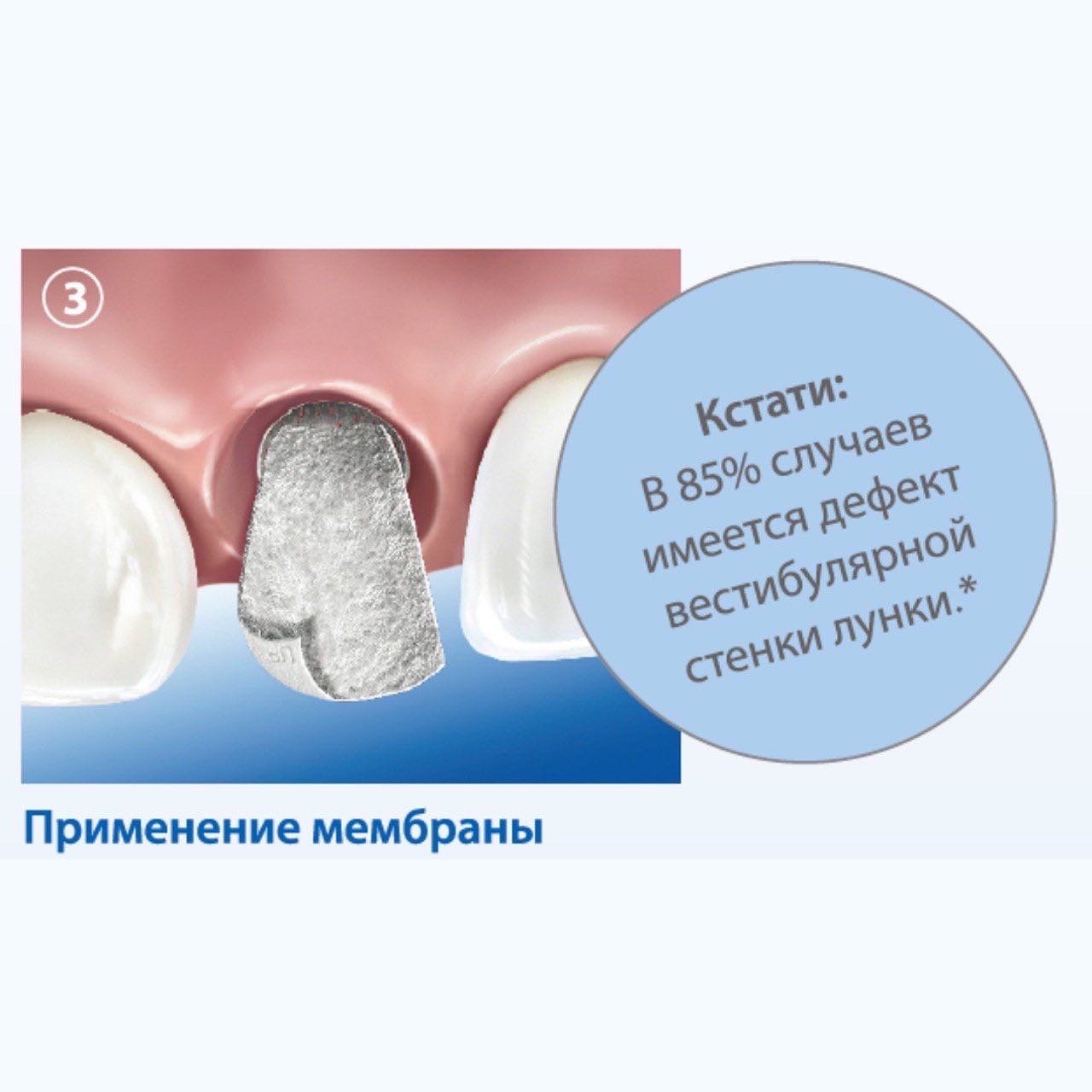 Методика сохранения альвеолярного гребня